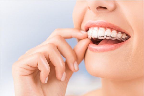 Niềng răng trong suốt ở Nhật Bản Niềng răng trong suốt ở Nhật Bản
