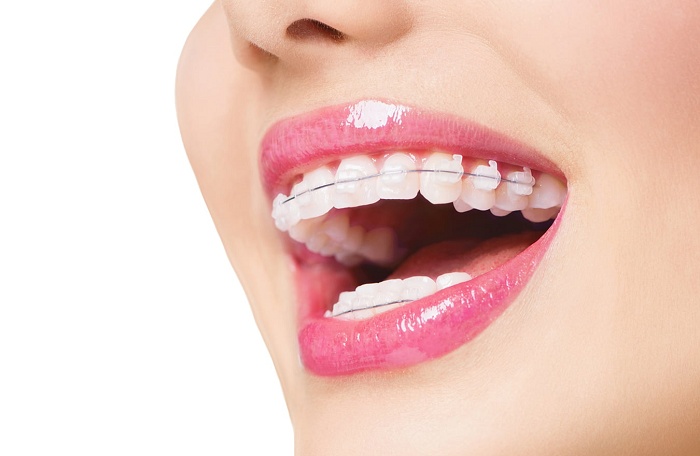Niềng răng uy tín giá rẻ tại Hà Nội