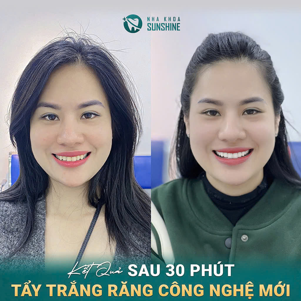 tay-trang-rang-cong-nghe-whitemax4.0-hieu-qua