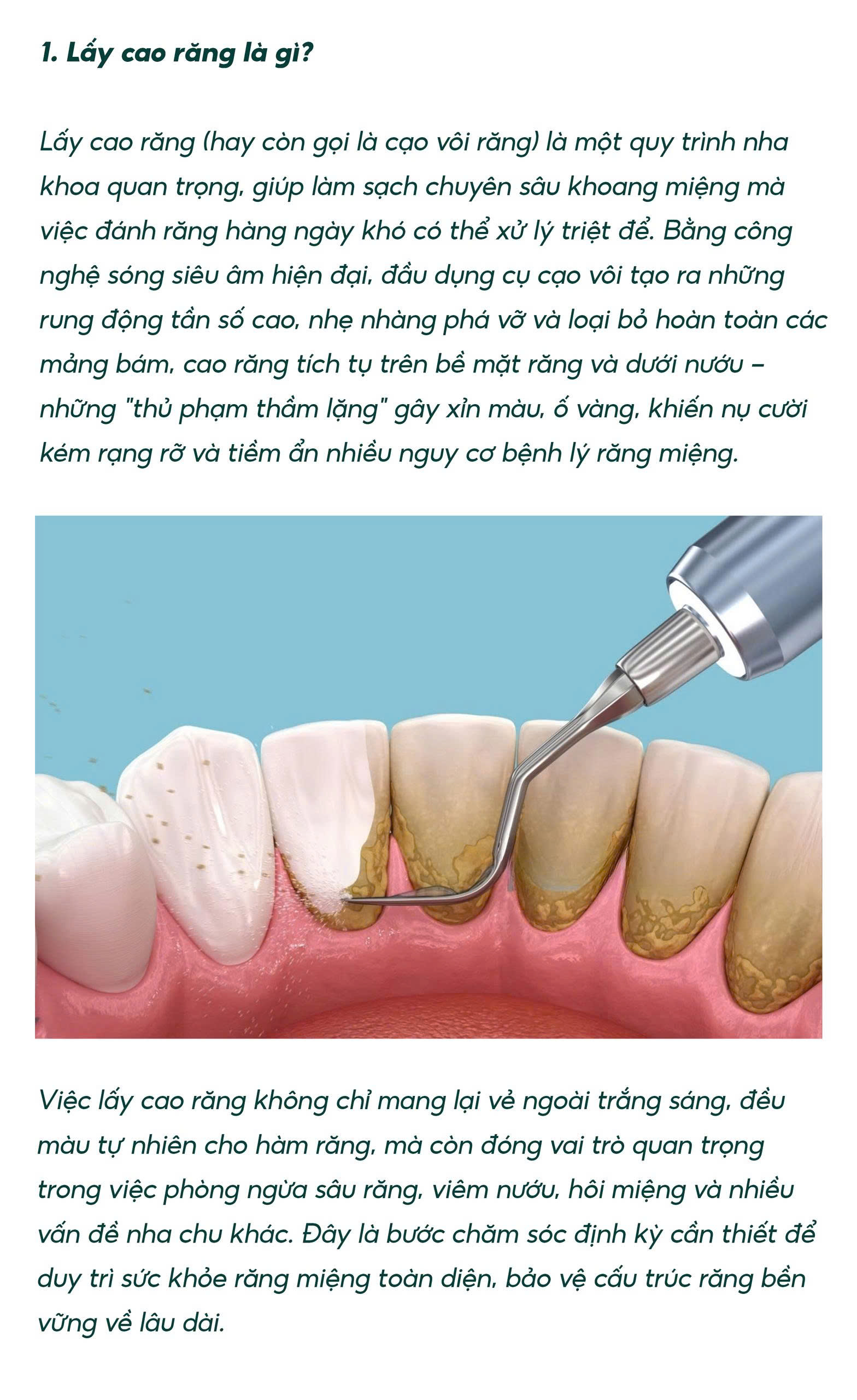 Lấy cao răng