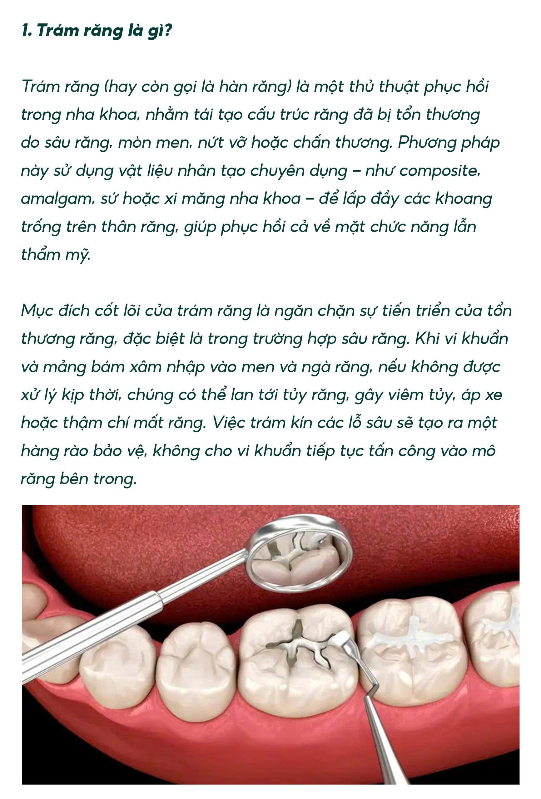Trám Răng