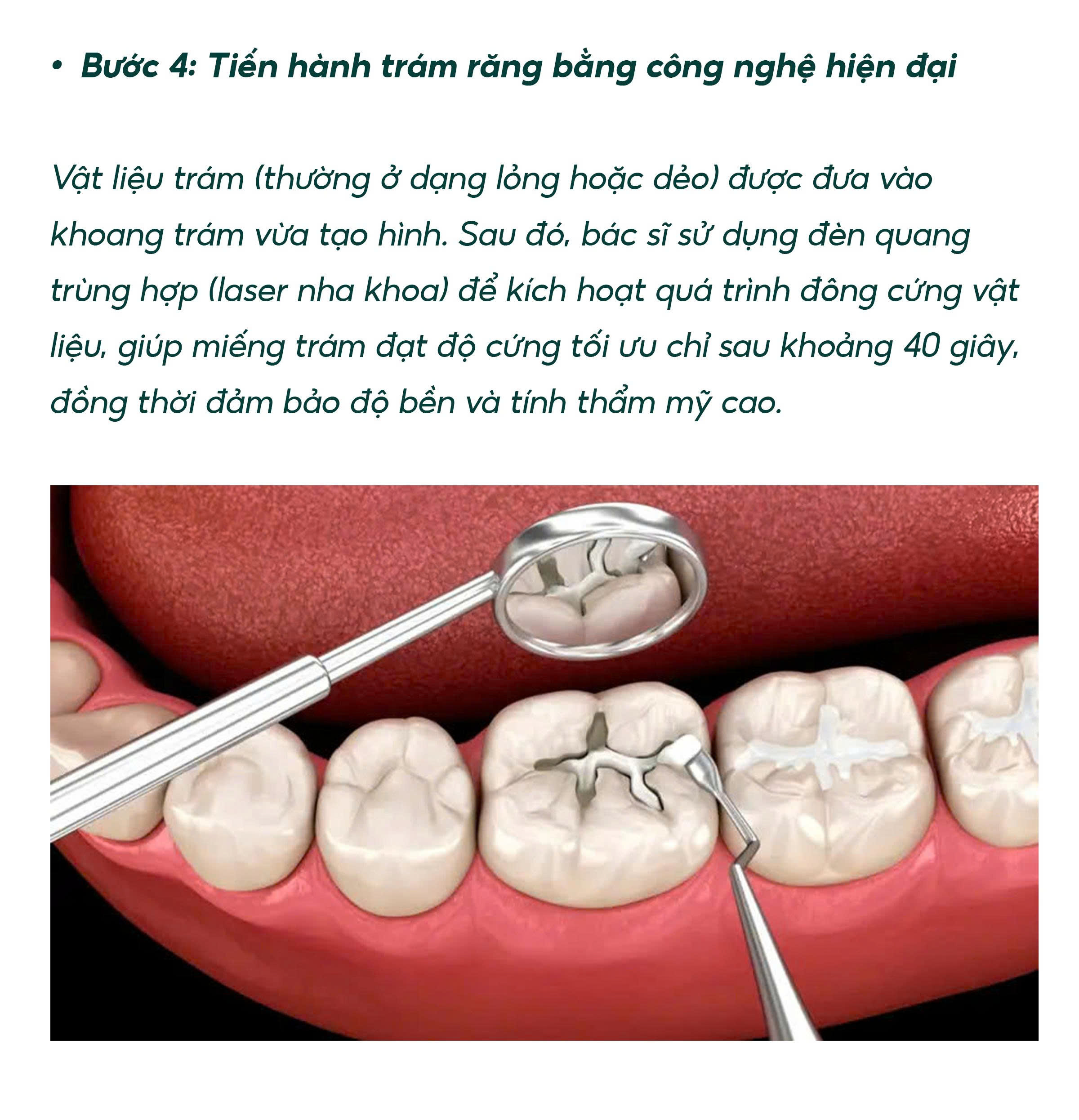 Trám Răng