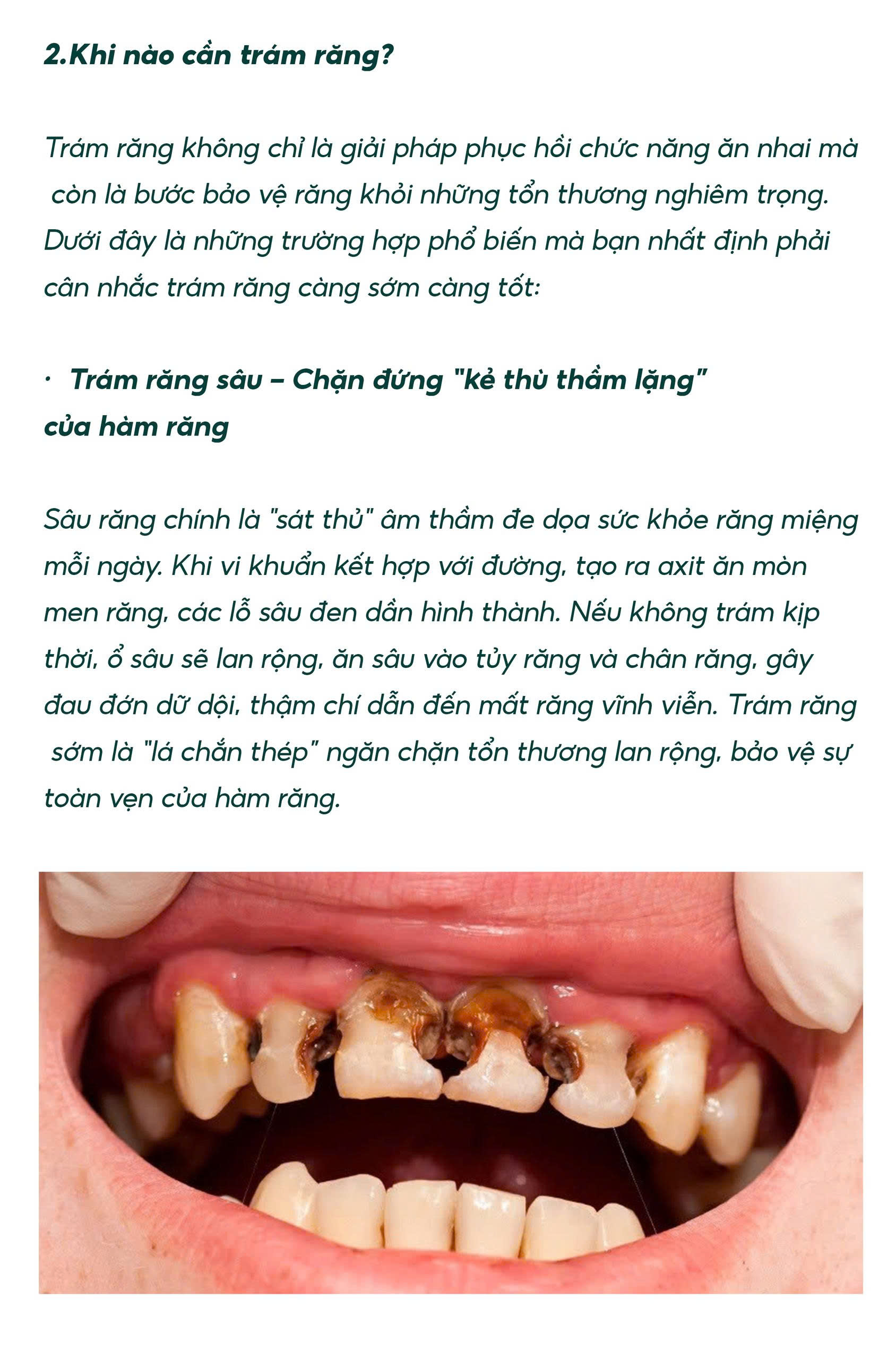 Trám Răng