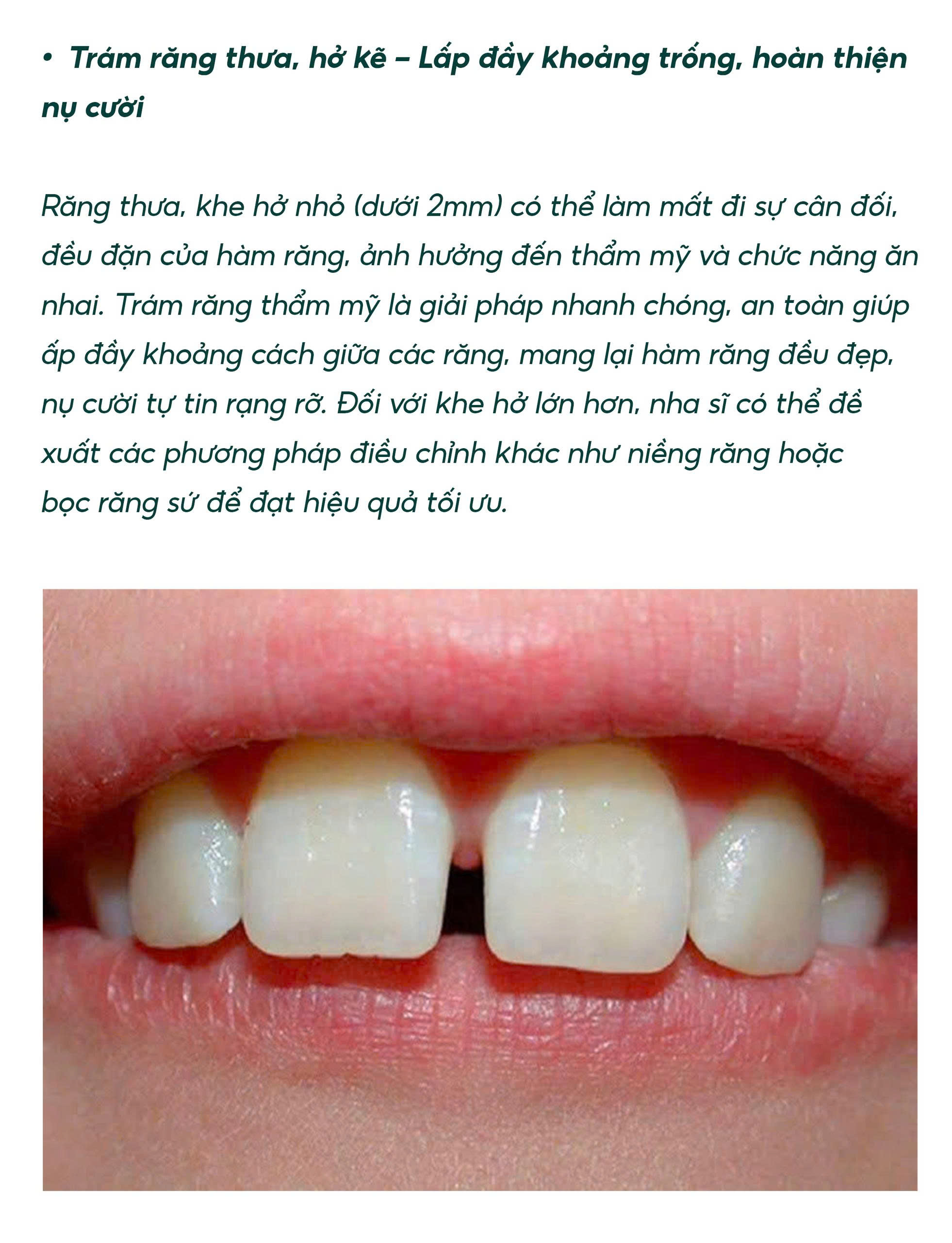 Trám Răng