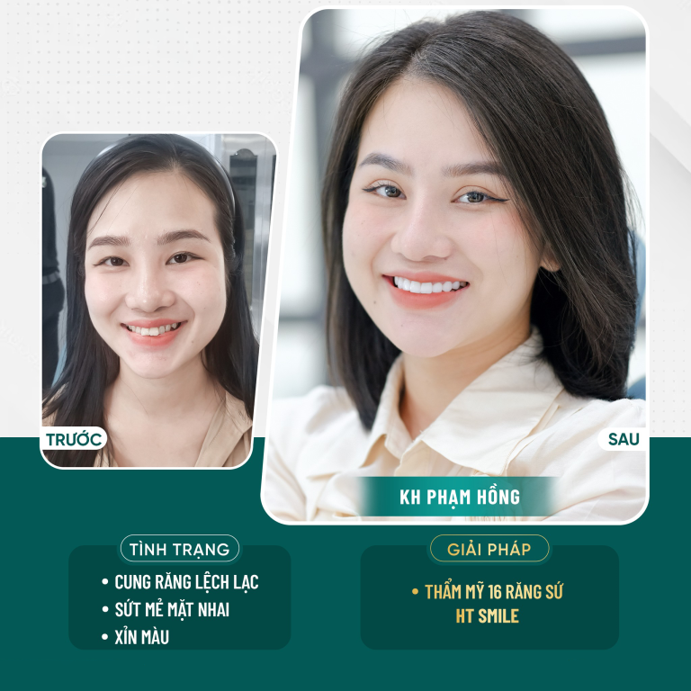 hinh-anh-truoc-va-sau-khi-boc-rang-su-ht-smile