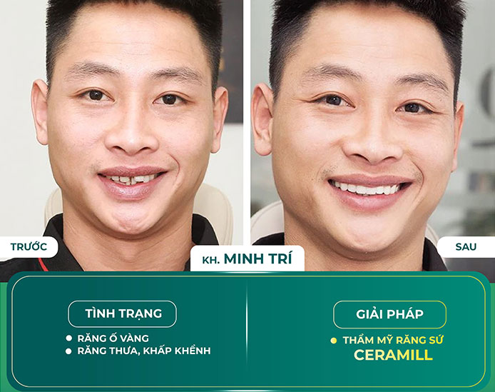 khach-hang-boc-rang-su-ceramill