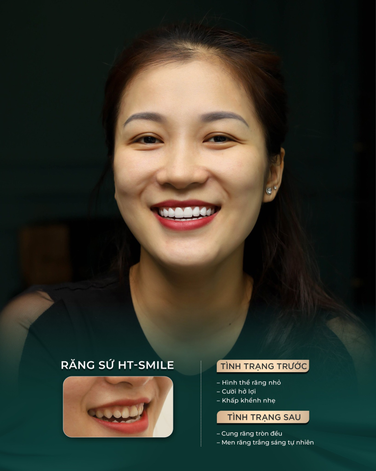 nu-cuoi-rang-su-ht-smile