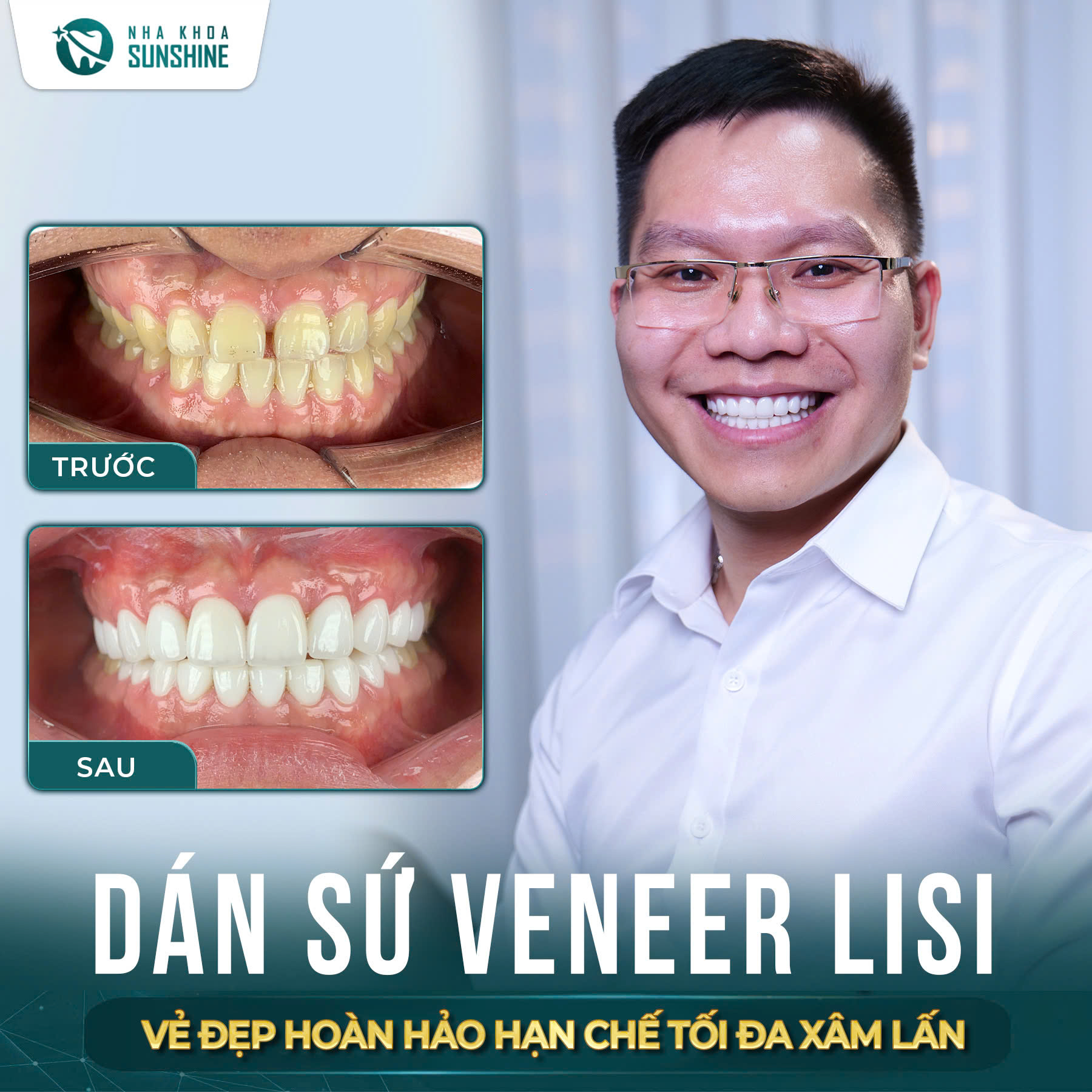 Khách hàng đóng khe thưa bằng Dán Sứ Veneer