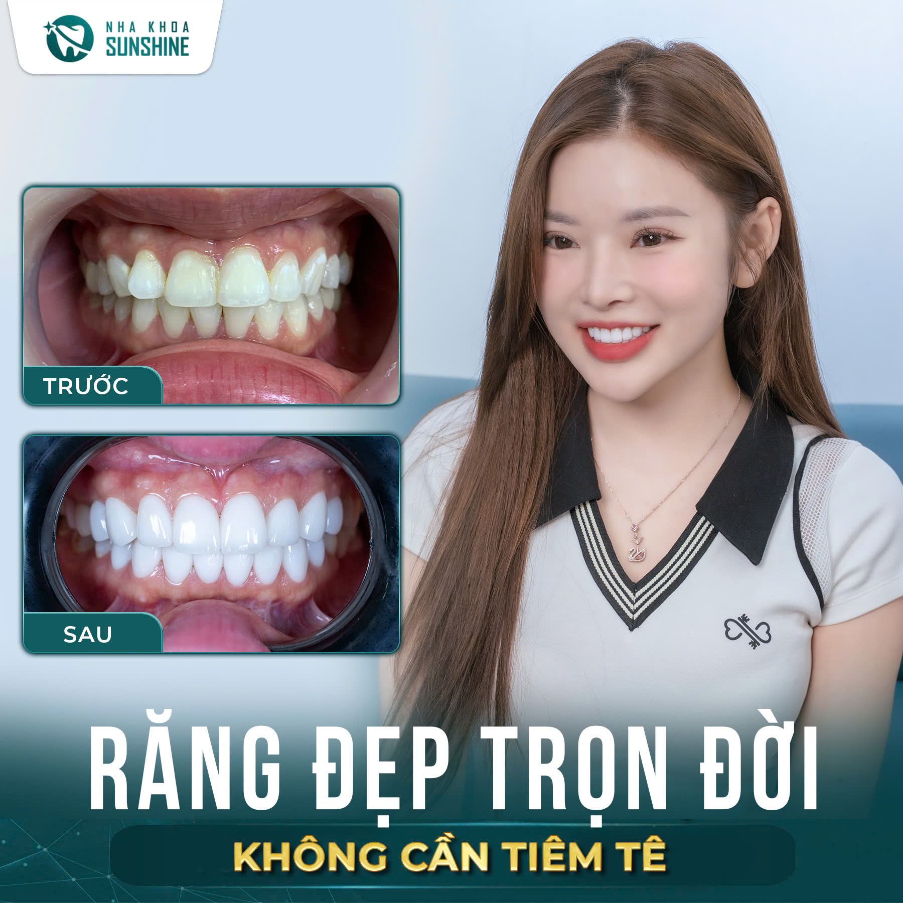 Khách hàng nâng tông nụ cười với Veneer Lisi