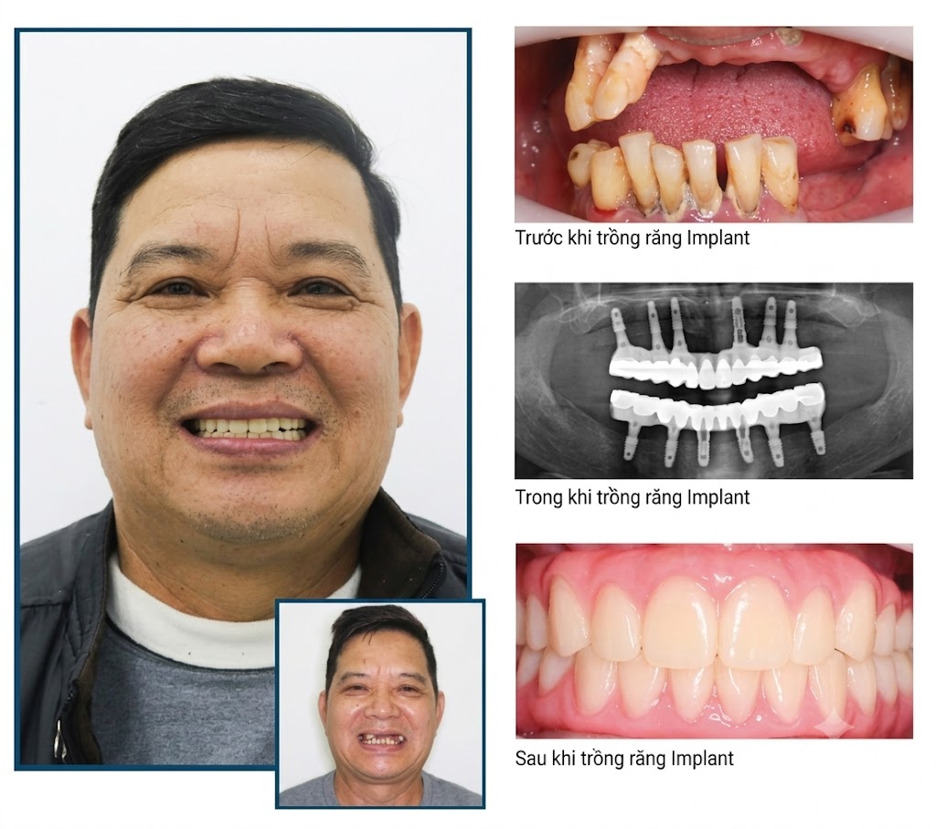 Chú Hùng trồng răng Implant toàn hàm All-on-4
