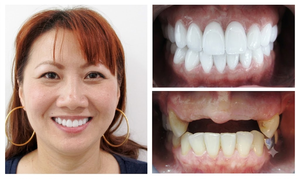 Chị Trang cấy trụ Implant phục hồi răng cửa