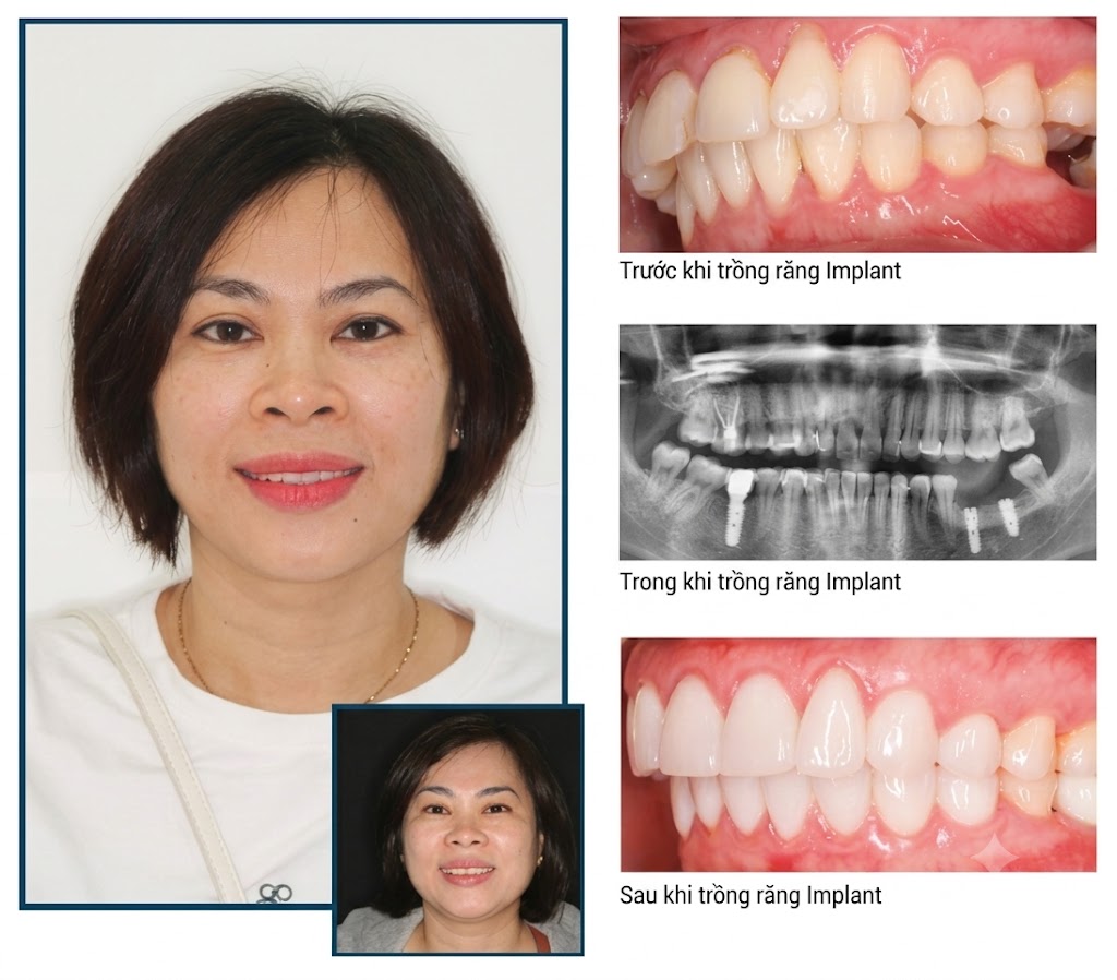 Anh Bảo trồng răng Implant phục hồi răng hàm