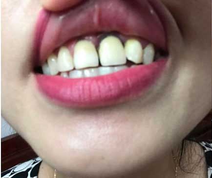 bọc răng sứ bị đen chân răng