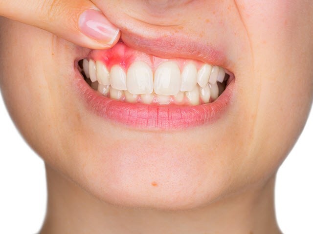 bọc răng sứ bị viêm lợi