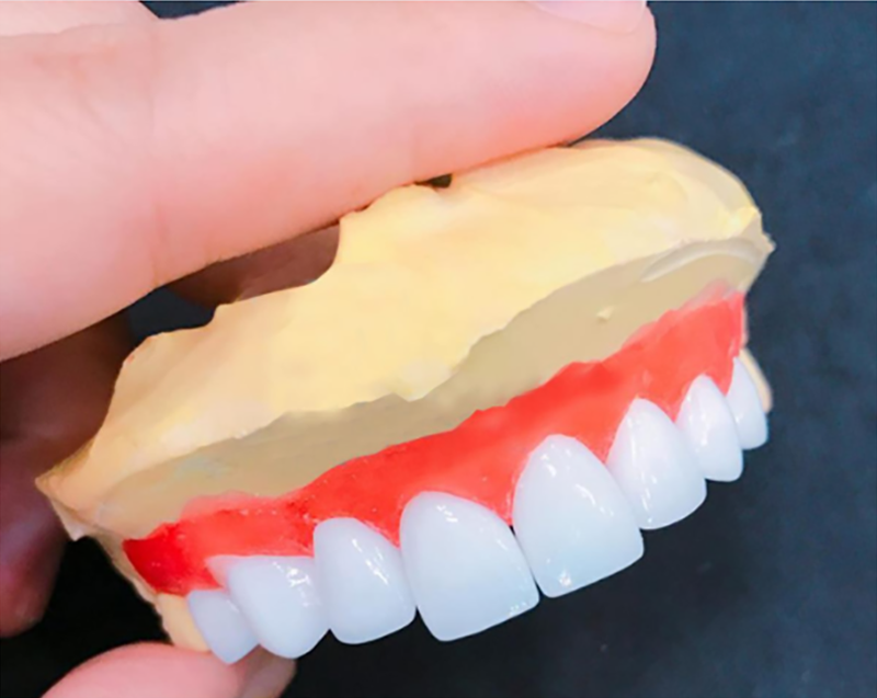 bọc răng sứ hàm dưới