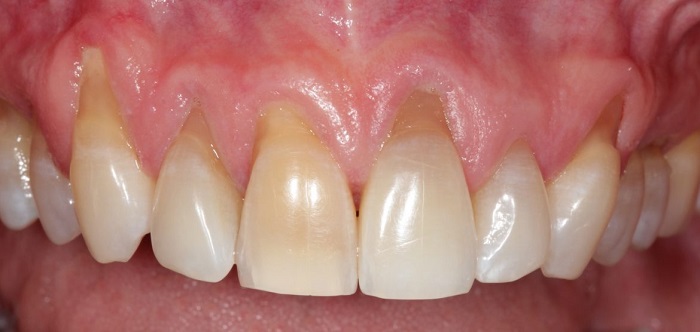 bọc răng sứ phần chân răng bị hở