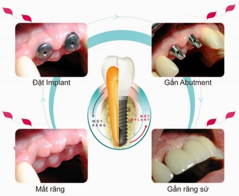 gia-implant-dentium-han-quoc-5.jpg