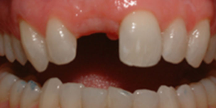 làm răng sứ implant