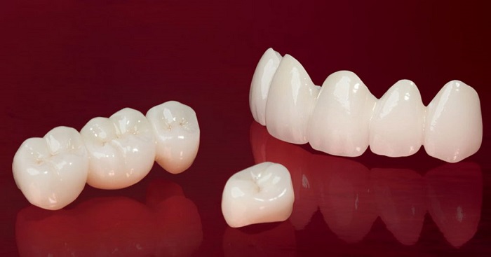 răng sứ emax là gì