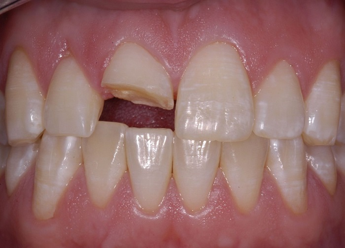 răng sứ kim loại ceramco