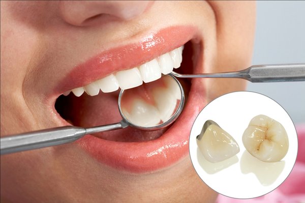 răng sứ kim loại là gì
